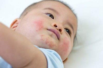 Votre enfant fait de l'eczema?